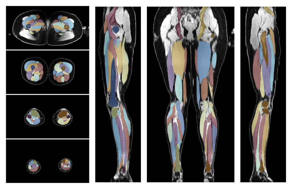 Overlay of automated muscle segmentation labels on dixon water image.